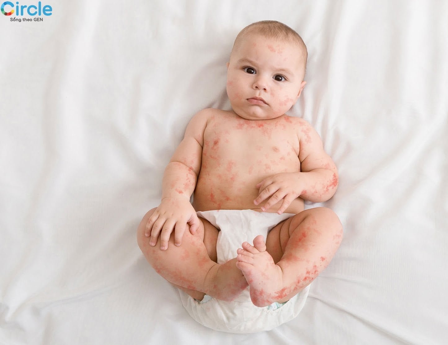 Khoảng 2 - 7,5% trẻ em bị dị ứng với đạm sửa bò và tình trạng này thường sẽ chấm dứt trước 3 tuổi. 